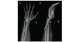 A) Anteroposteriore bzw. B) laterale Röntgenaufnahme des linken Unterarms