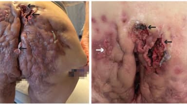 Schmerzhafte und ausgedehnte Ulzera am Gesäß