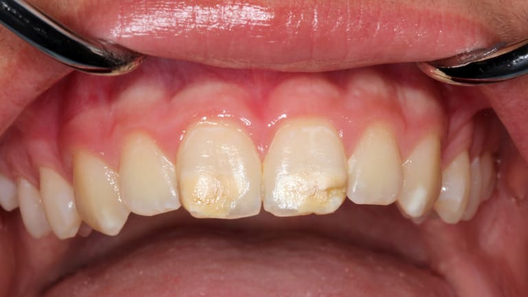 "Kreidezähne" - hier sind Vorderzähne eines Kindes betroffen