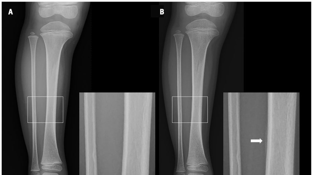 Röntgenaufnahmen des rechten Unterschenkels eines 3-jährigen Mädchens, aufgenommen (A) am Tag der Verletzung und (B) 11 Tage nach der Verletzung.