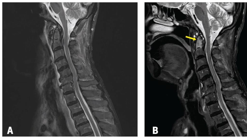MRT-Aufnahme des Schädels und Halses, bei Aufnahme und einen Monat später