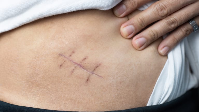 Management der akuten Appendizitis: Antibiose als OP-Alternative 