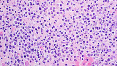 H&E-Färbung, Lichtmikroskopie, Multiples Myelom 