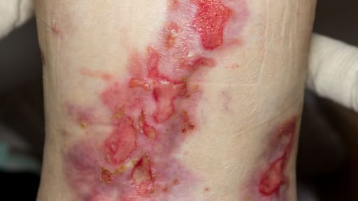 Epidermolysis bullosa