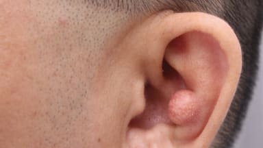 Fleischfarbener Knoten am Oh