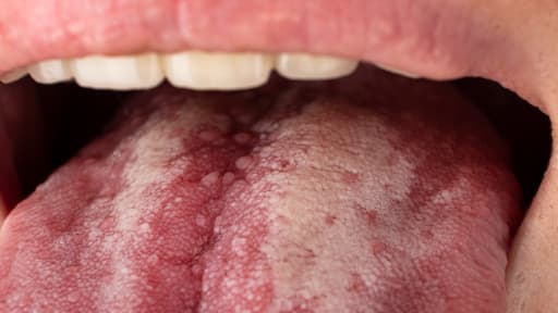 Zunge mit weißem Belag