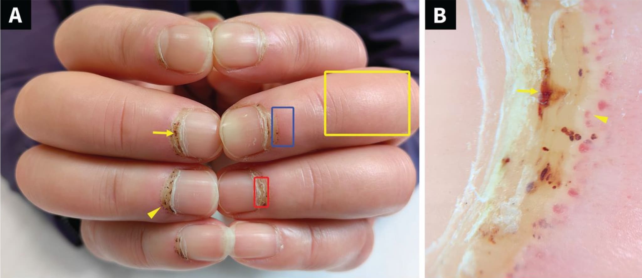 Bild der Woche Dicke Finger und dunkle Nagelfalzkapillaren