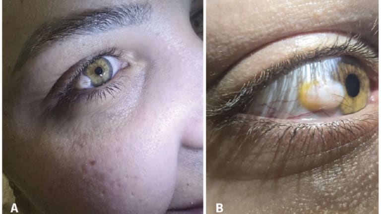 26-Jährige mit behaartem Knötchen im Auge