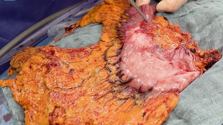 Gastrektomie, subtotal, robotisch assistiert