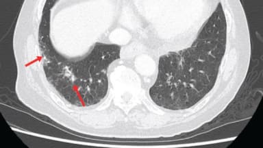 Die Computertomographie zeigt körnige und interstitielle Schatten in der Lunge