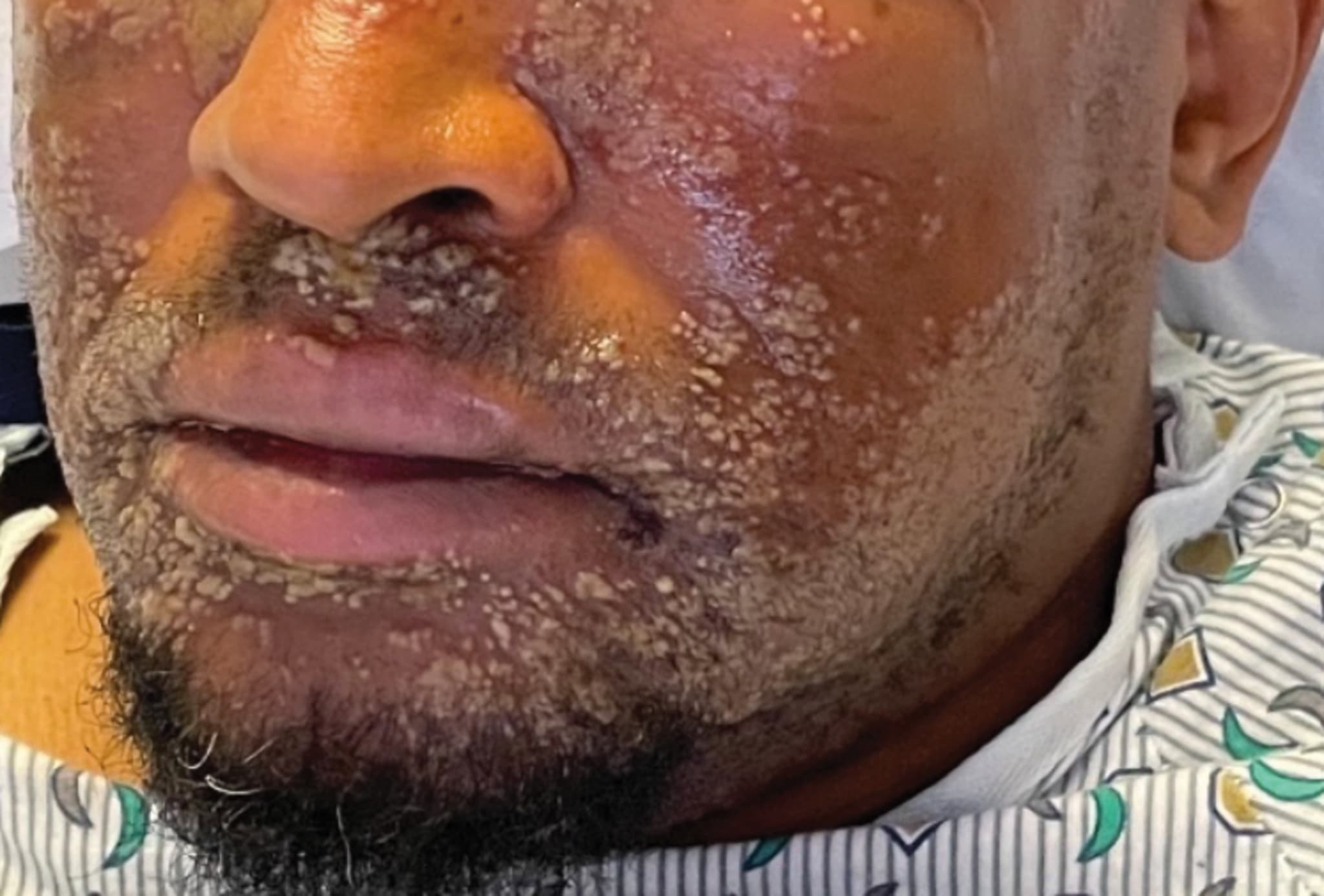 elfbar elfa kaufen What Does A Vape Rash Look Like? main image 1