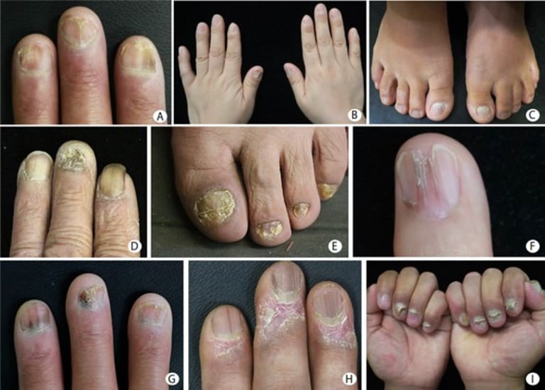Verschiedene Nagelveränderungen bei Lichen planus