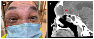 Bild der Woche Geschwollenes Auge