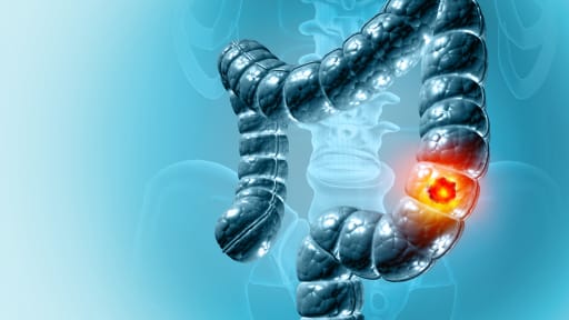 Wichtigste Insights zu GI-Tumoren 