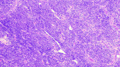 Follikuläres Lymphom und diffus großzellige B‑Zell-Lymphom in EU zugelassen