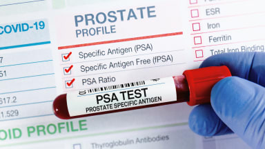 Cochrane Review: PSA-Screening senkt wahrscheinlich die Sterblichkeit durch Prostatakrebs
