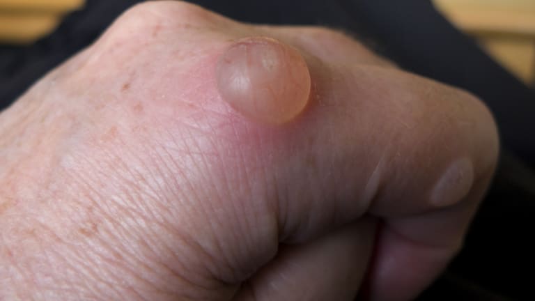 Lokaltherapeutisches Vorgehen bei Blasen