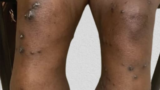 Bild der Woche: Weiße Knötchen auf den Beinen