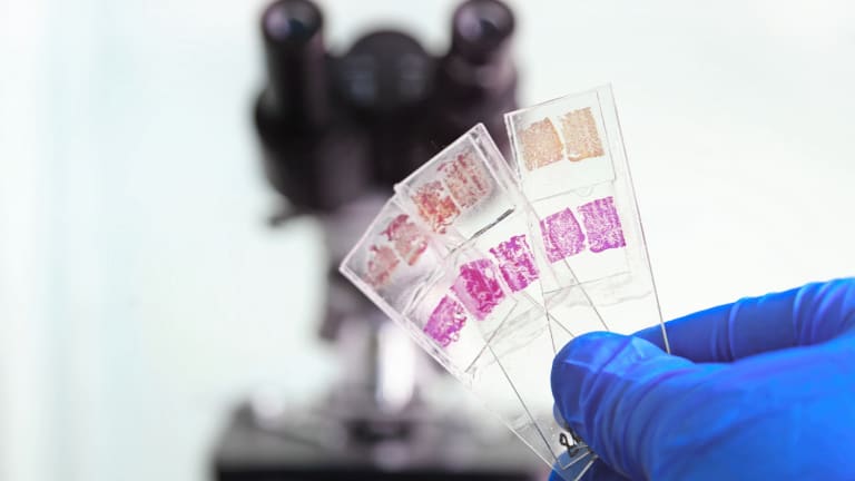 Tumorverschleppung nach Nierentumor-Biopsie 