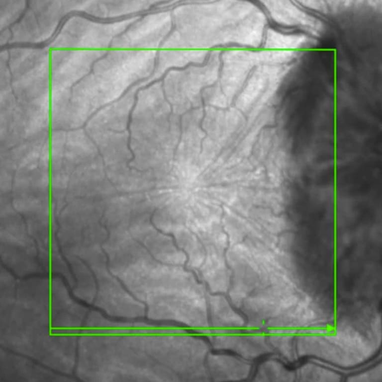 Beidseitige Papillenschwellung Abb. 3: OCT-Aufnahme des rechten Auges mit Zunahme der Papillenschwellung und neu aufgetretenen Aderhautfalten