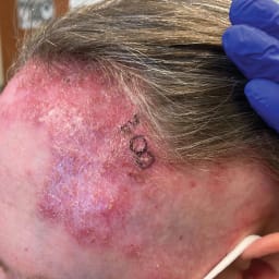 Alopezie und juckender Ausschlag an Stirn und Kopfhaut