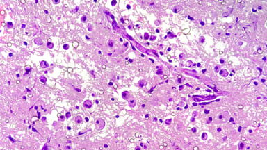 Stark vergrößerte Ansicht eines Hirntumors. Oligodendrogliom des Gehirns. Gliom des Gehirns. Histologischer Objektträger unter Mikroskopie.