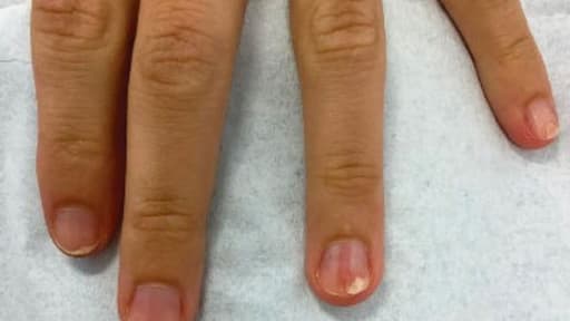 Schmerzempfindlicher Fingernagel mit roter Linie