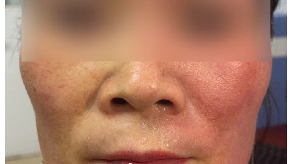 50-jährige  Patientin, mit Rötung der linken Gesichtshälfte