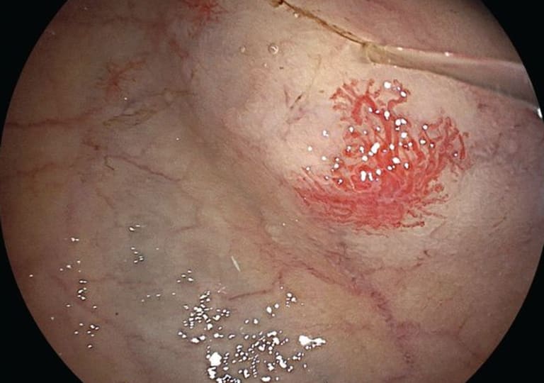 Diffuse, kleine bis flächenhafte rötliche Gefäßveränderungen im Bulbus duodeni