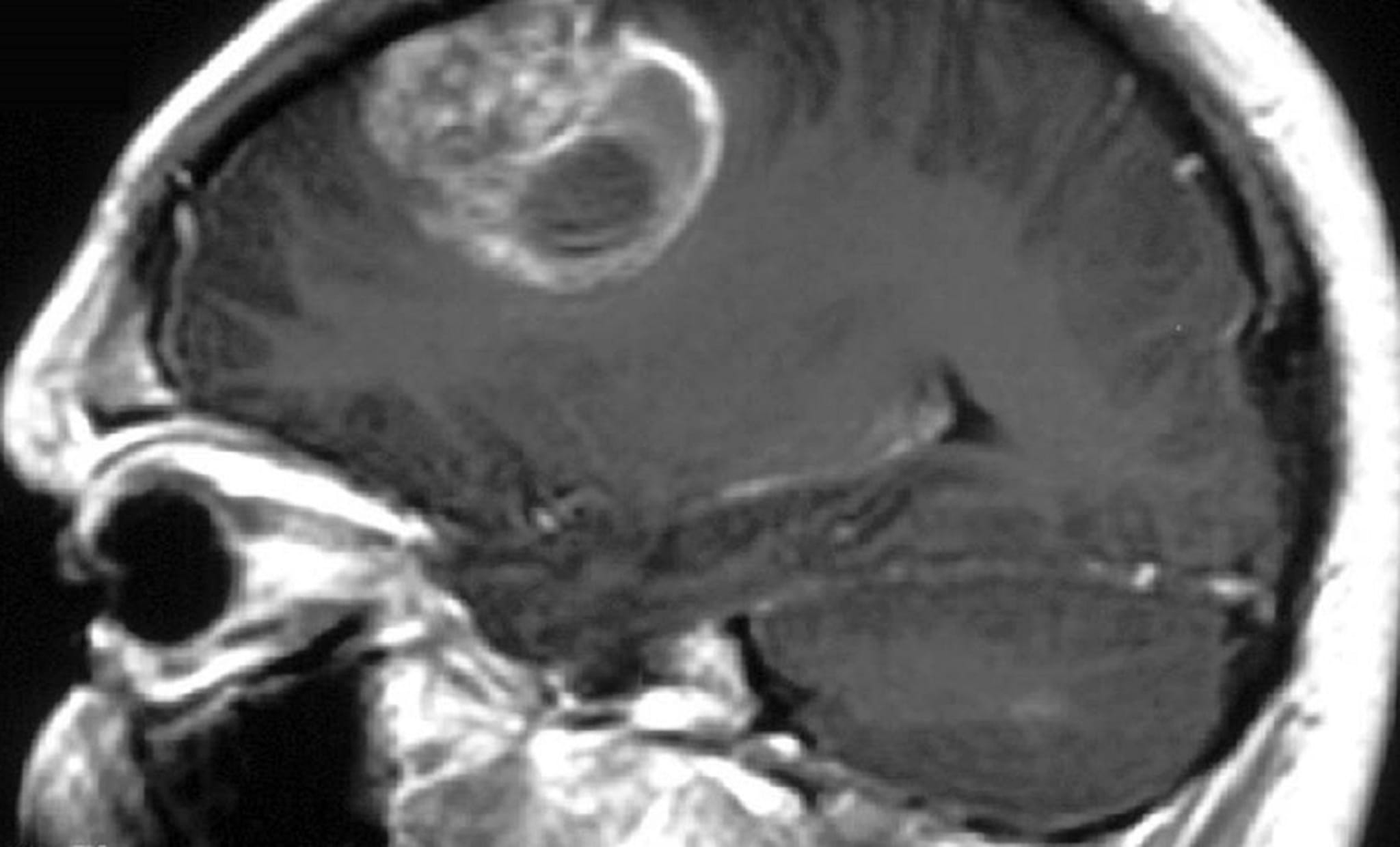 Interview Neue Bausteine in der Hirntumortherapie