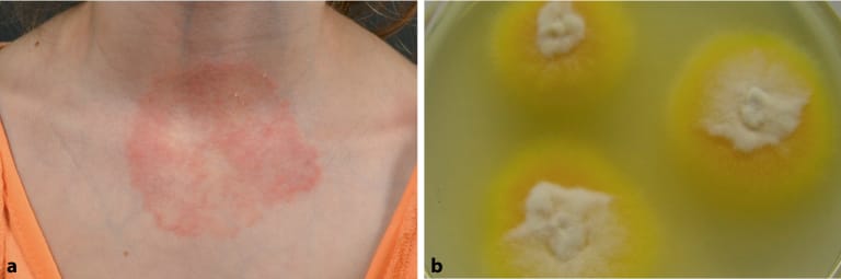 Pilzinfektionen der Haut bei Kindern