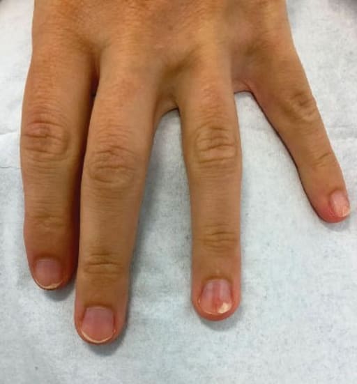 Schmerzempfindlicher Fingernagel mit roter Linie