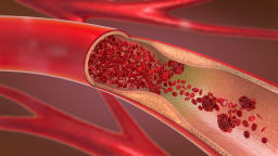 verstopfte Arterie