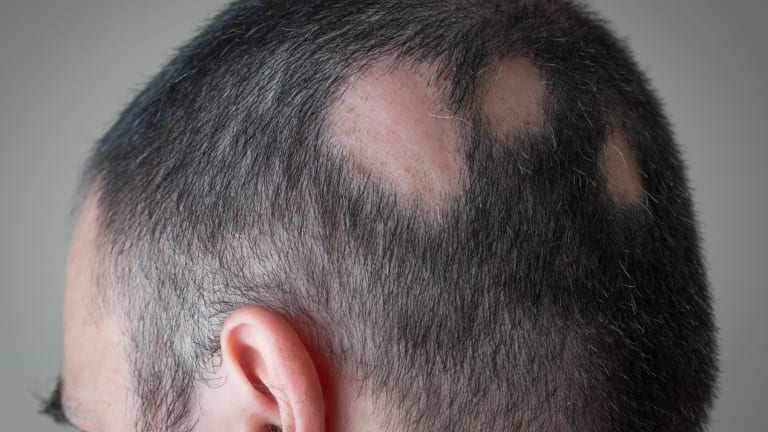 Alopecia areata
