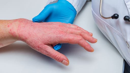 Neue Empfehlungen zu altbekannten Hautkrankheiten