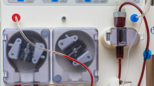 Bessere Überlebenschancen mit Peritonealdialyse statt Hämodialyse?