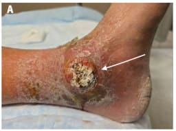 Erhabene, rundliche, ulzerierende Läsion mit kreideartigem Zentrum und umgebendem Erythem