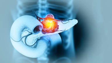 Transarterielle Mikroperfusion beim lokal fortgeschrittenen Pankreaskarzinom