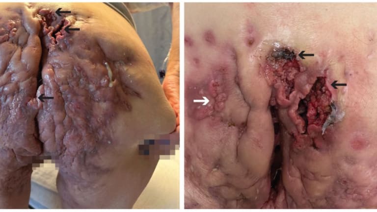 Schmerzhafte und ausgedehnte Ulzera am Gesäß