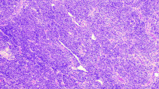 Follikuläres Lymphom und diffus großzellige B‑Zell-Lymphom in EU zugelassen