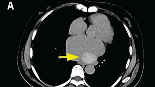 Atemnot nach plötzlichem Absetzen eines Medikamentes 