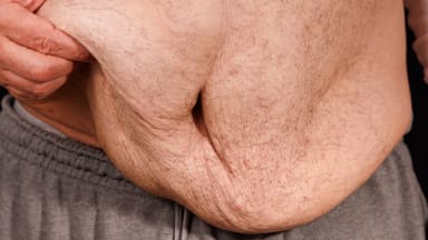 GLP-1-Medikamente: Neue Herausforderungen für die ästhetische Medizin