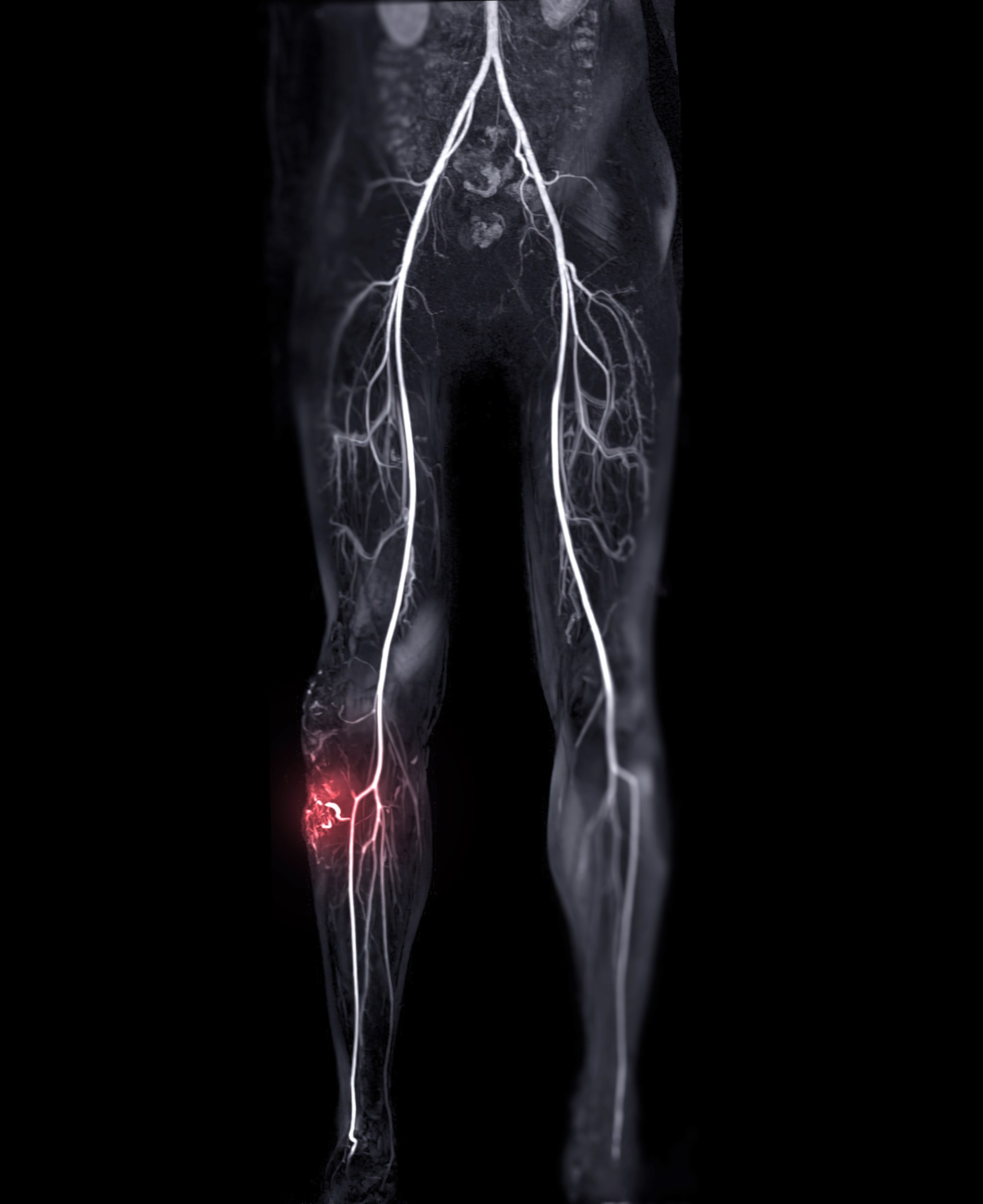 Akute Ischämie der Extremitäten: Diagnose und interventionelle Therapie - coliquio