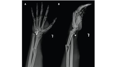 A) Anteroposteriore bzw. B) laterale Röntgenaufnahme des linken Unterarms