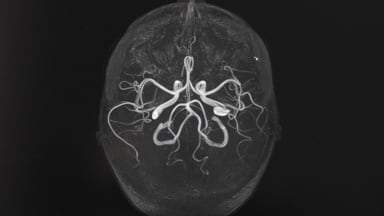 Tickende Zeitbombe intrakranielles Aneurysma betrifft Millionen