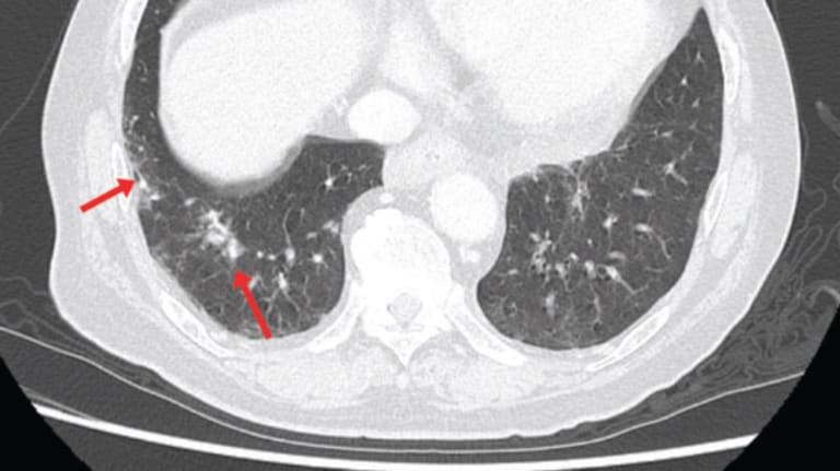 Die Computertomographie zeigt körnige und interstitielle Schatten in der Lunge