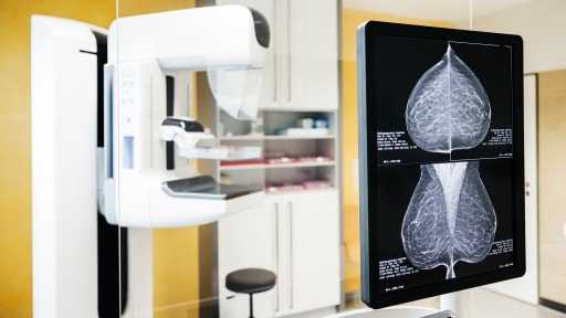 Brustkrebserkennung durch Mammographie