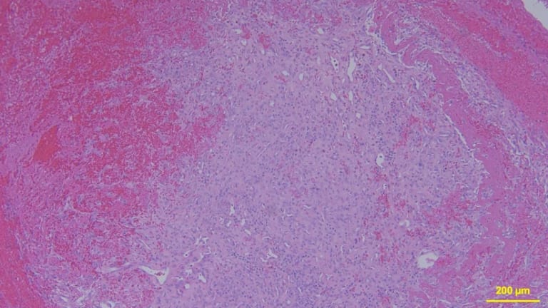  Exemplarischer mikroskopischer Befund der exstirpierten Raumforderung. HE-Färbung