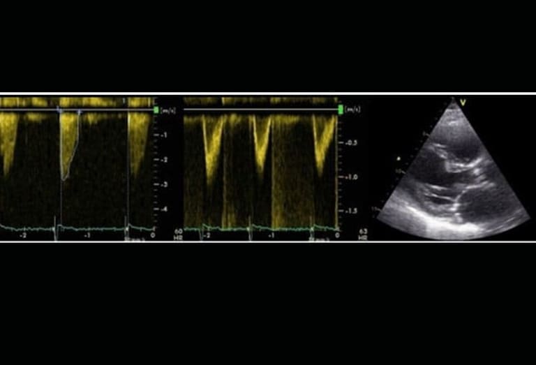 Aortenstenose