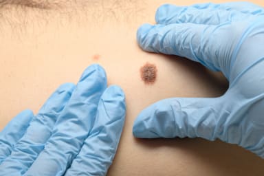 Wichtige Innovationen in der Melanom-Therapie
